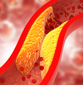 Cholesterol and Statins